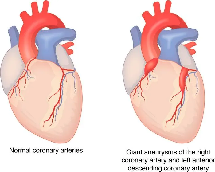 Normal vs. Aneurysmal Coronary Arteries in Kawasaki Disease