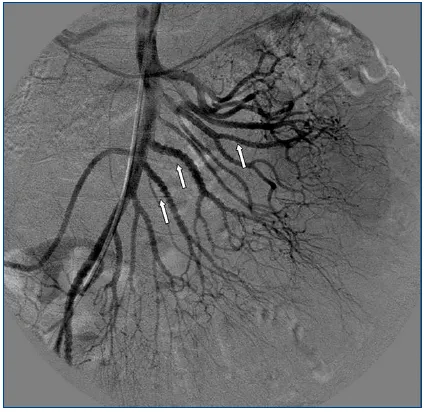 Renal artery microaneurysms in polyarteritis nodosa