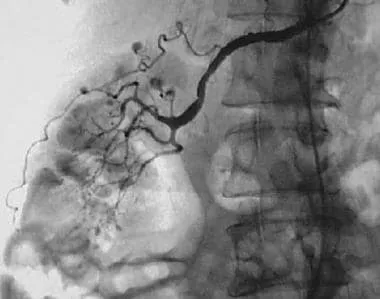 Renal angiogram: Polyarteritis Nodosa "beads on a string"