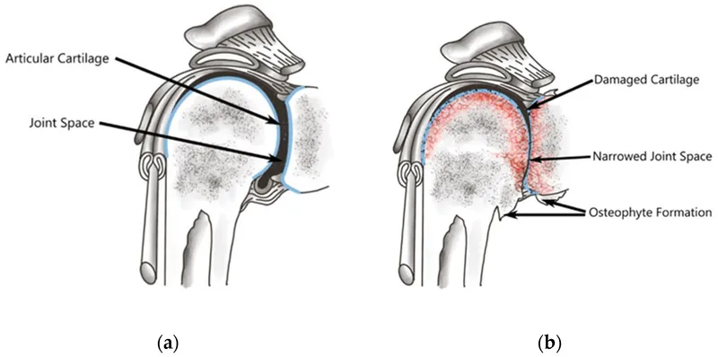 Healthy vs. Osteoarthritic Joint