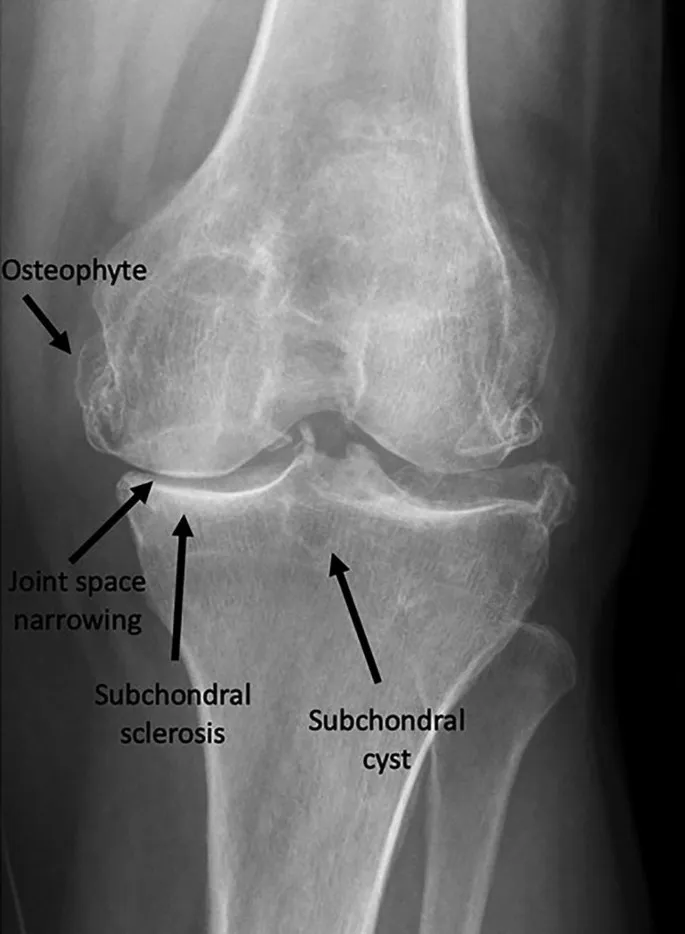 Annotated X-ray of osteoarthritic knee