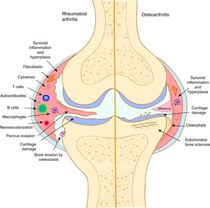 Rheumatoid Arthritis vs. Osteoarthritis Joint Comparison