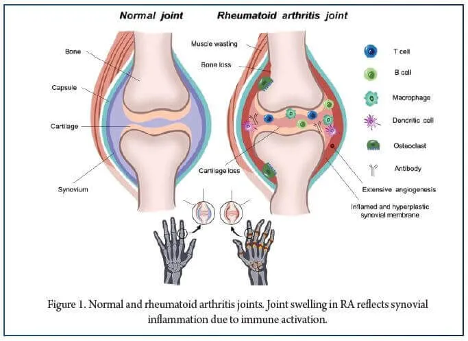 Normal vs. Rheumatoid Arthritis Joint Comparison