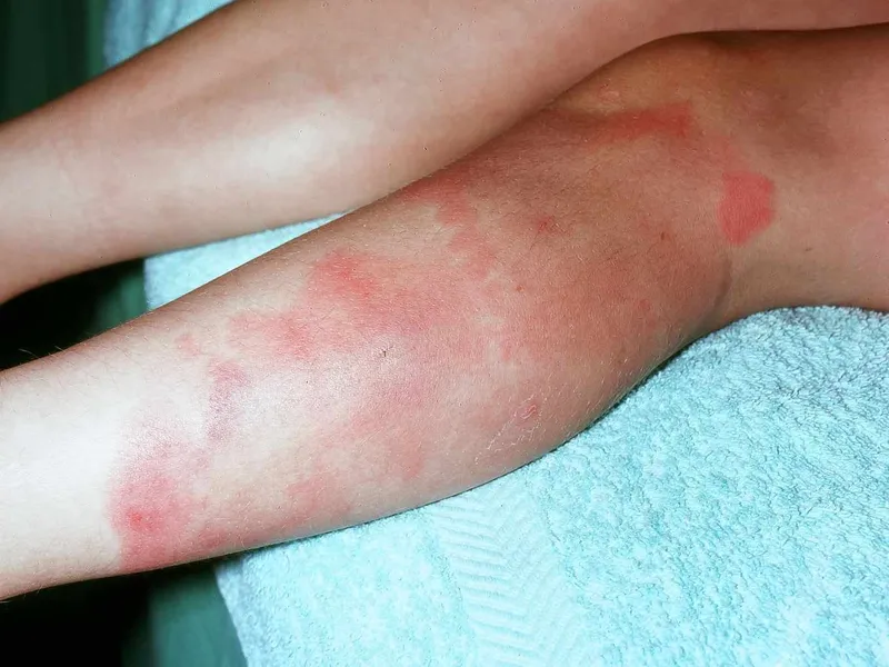Erythema Nodosum on Shins
