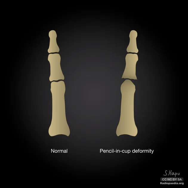 Pencil-in-cup deformity in psoriatic arthritis