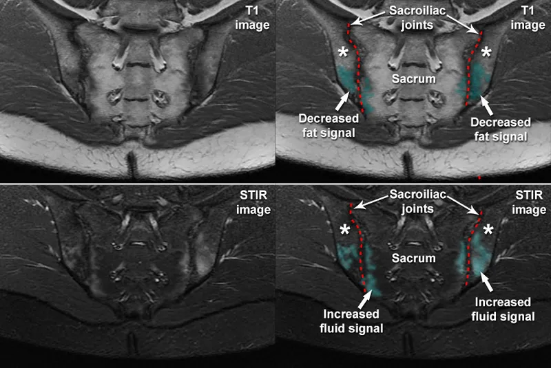 MRI of sacroiliitis in seronegative spondyloarthropathy