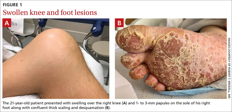 Keratoderma blennorrhagicum on foot and swollen knee