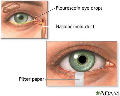 Schirmer test and fluorescein eye drops for dry eyes