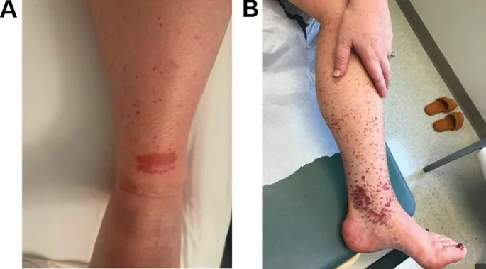 Palpable Purpura in Small Vessel Vasculitis