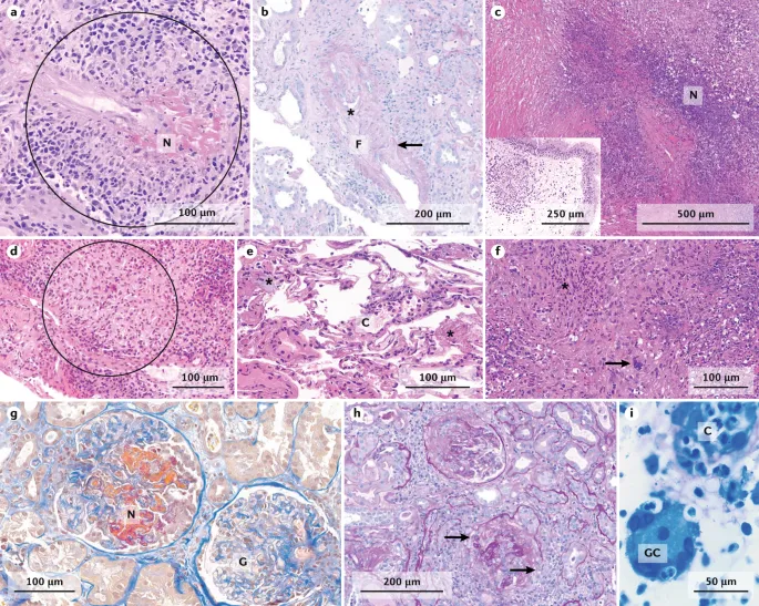 Histology of ANCA-associated and immune complex vasculitis