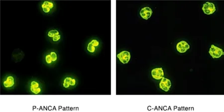 P-ANCA vs C-ANCA Immunofluorescence Patterns