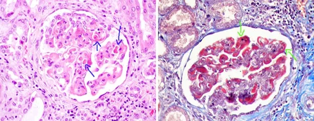 Lupus Nephritis: Glomerular Immune Complex Deposition