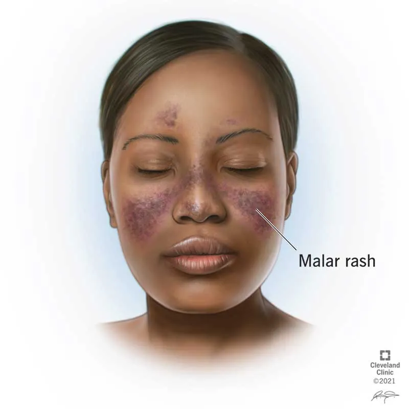 Malar rash in systemic lupus erythematosus
