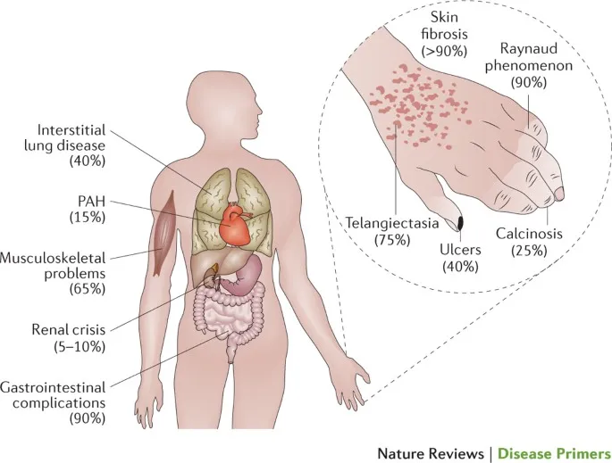 Systemic Sclerosis: Multi-organ Manifestations