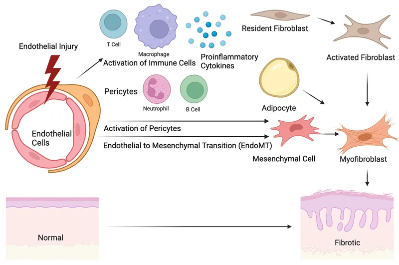 Scleroderma Pathophysiology: Endothelial Injury to Fibrosis
