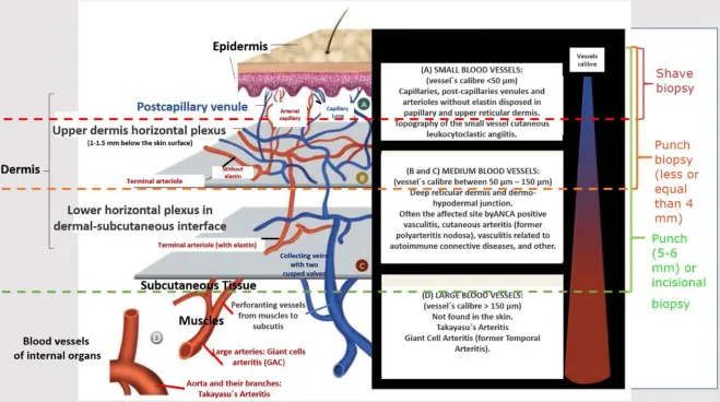 Vasculitides Classification by Vessel Size and Biopsy Type