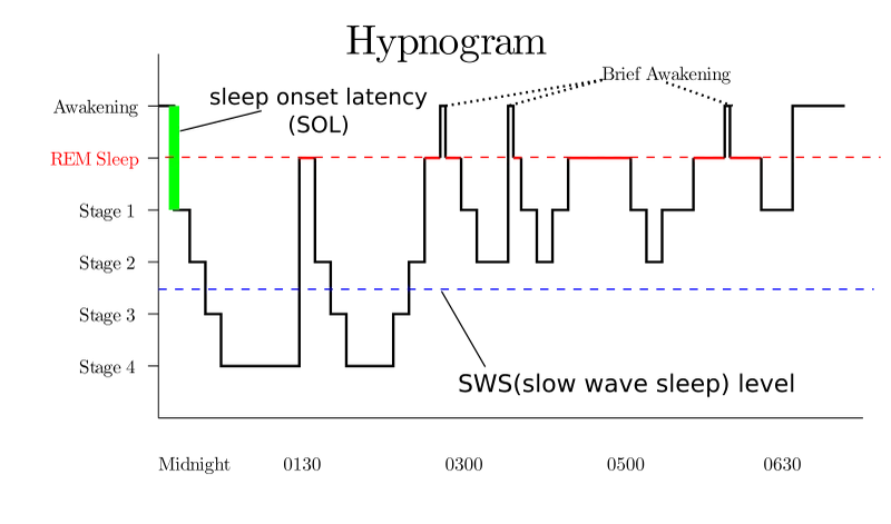 Typical hypnogram showing sleep stages