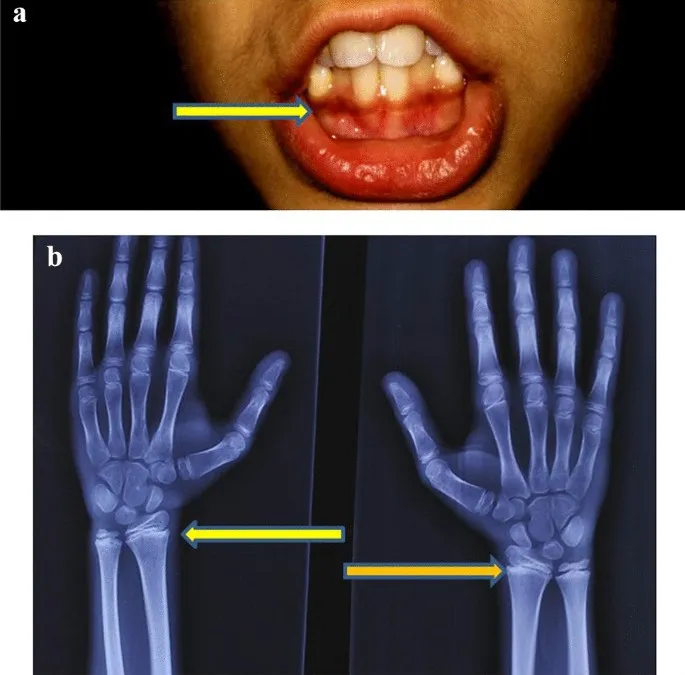 Burtonian line and lead lines in lead poisoning