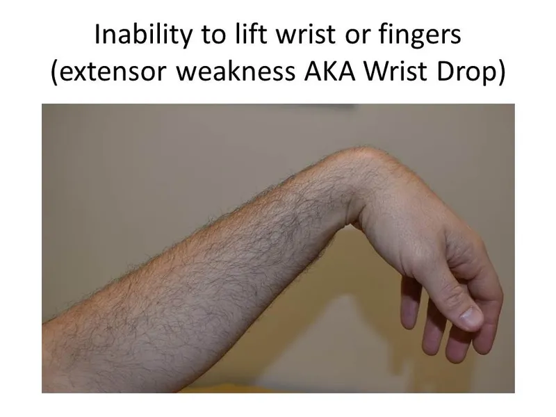 Wrist Drop (Extensor Weakness)