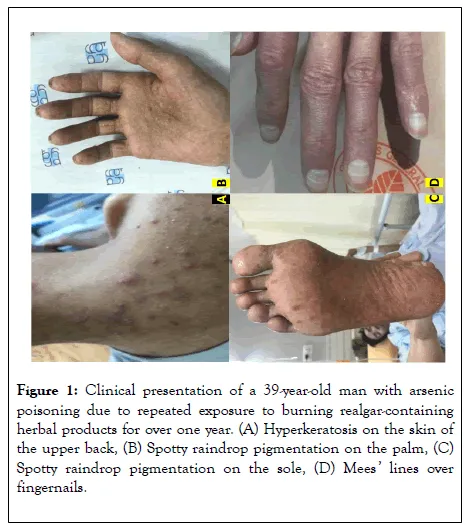 Arsenic poisoning skin manifestations