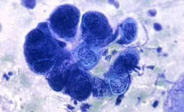 Tzanck smear: multinucleated giant cells
