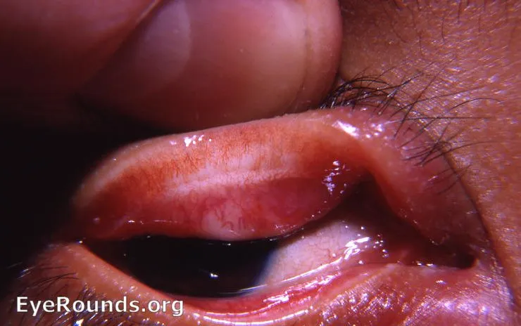 Trachoma: Arlt's line and Herbert's pits