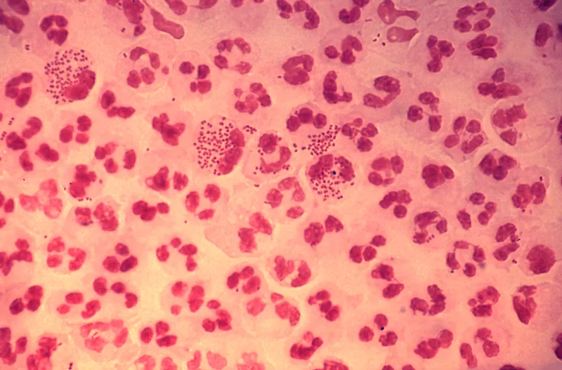 Gram stain of Neisseria gonorrhoeae