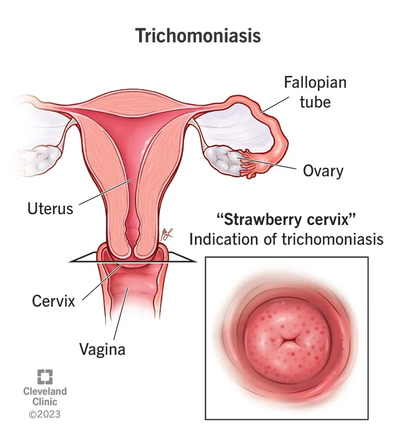 Trichomoniasis "strawberry cervix" indication