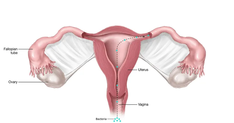 PID infection spread in female reproductive tract