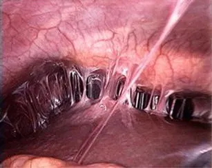 Fitz-Hugh-Curtis syndrome violin-string adhesions
