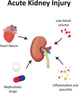 Causes of Acute Kidney Injury