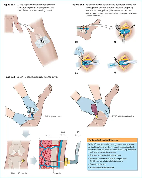 Vascular Access: IV, Venous Cutdown, and IO