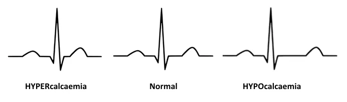 ECG changes in hypercalcemia vs hypocalcemia