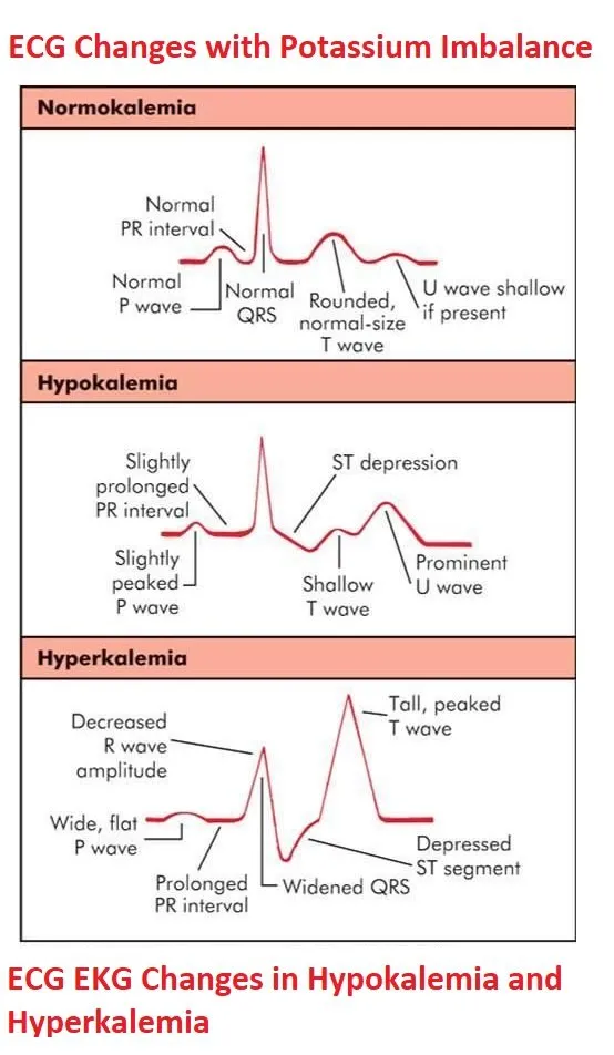 ECG changes in hypokalemia and hyperkalemia