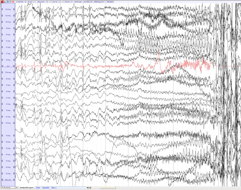 EEG showing status epilepticus with continuous spiking