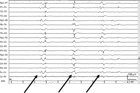 EEG: Burst suppression pattern in status epilepticus