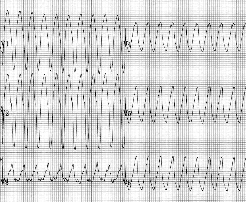ECG: Monomorphic VT degenerating into VF