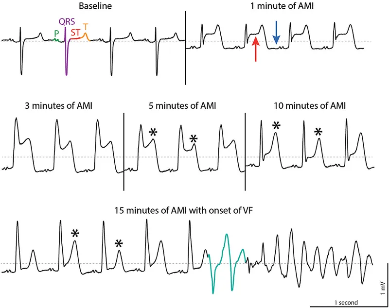 ECG progression to ventricular fibrillation post-MI