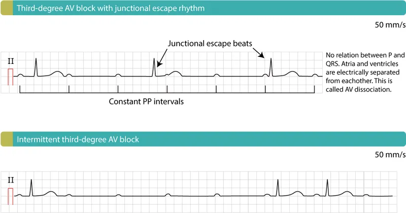 ECG: Third-degree AV block with junctional escape rhythm
