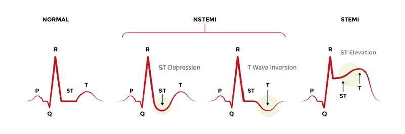 ECG changes in normal, NSTEMI, and STEMI