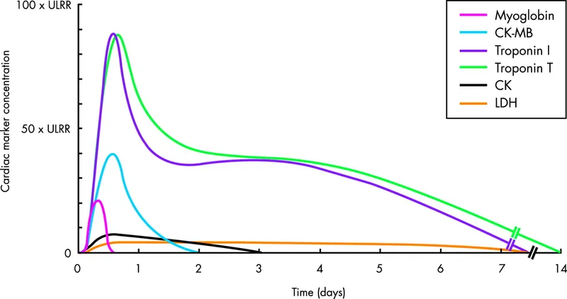 Cardiac biomarker temporal profile after MI