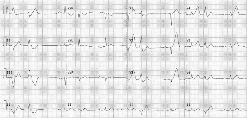 12-lead ECG showing acute anterior STEMI