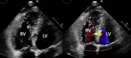 Doppler echo: Post-MI VSD with left-to-right shunt