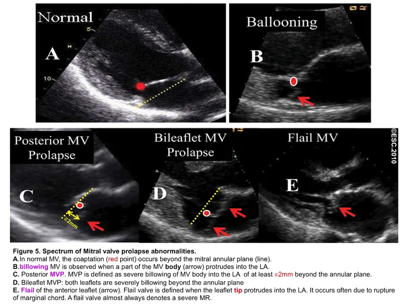 Echocardiogram: Mitral Valve Prolapse Spectrum