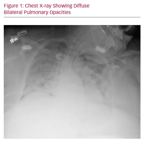 Chest X-ray: Diffuse Bilateral Pulmonary Opacities in ARDS