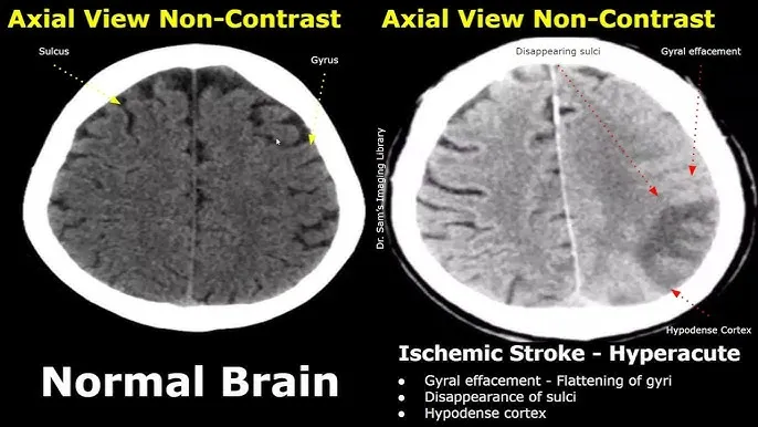 Non-contrast CT: Normal brain vs. hyperacute ischemic stroke