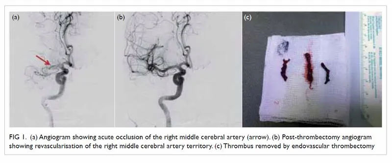 Endovascular thrombectomy for acute ischemic stroke