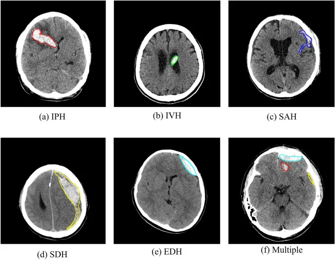 CT scans of various intracranial hemorrhages