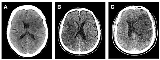 CT scan: Malignant MCA stroke progression