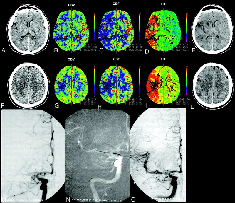 CT perfusion maps showing infarct core and penumbra mismatch